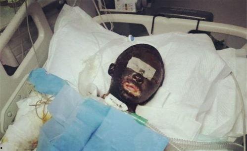 网红拉姆被烧伤视频,网红拉姆烧伤事件引发社会关注