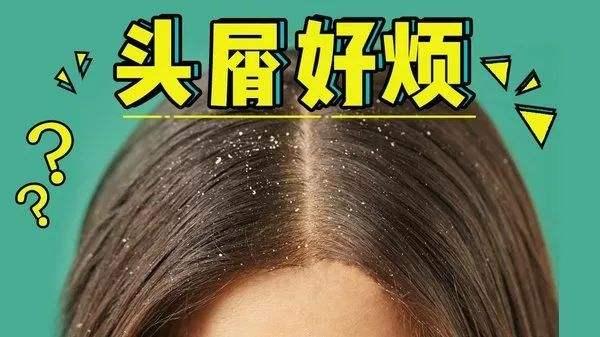 明星头皮屑,揭秘明星们的“头号烦恼”